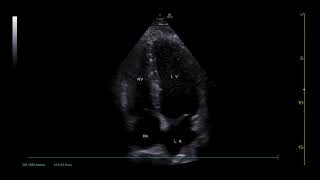 PoCUS Echo  Apical 4 Chamber A4C View [upl. by Skurnik690]