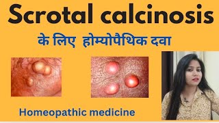 Scrotal calcinosis treatment  Scrotal calcinosis symptomscauses amp homeopathic medicine in hindi [upl. by Llenrap]