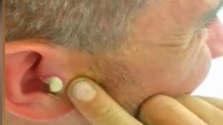 Squeezing Roufas Big Ear Pimple Medical Case Study 👍👍👍👍 [upl. by Tooley]