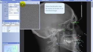 Making analyses in Planmeca Romexis® Cephalometric Analysis module [upl. by Hunsinger]