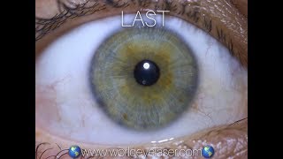 Worldeyelaser treatment for changing eye color WORLDEYELASER CLINIC [upl. by Amling]