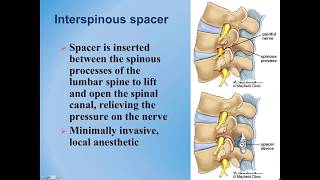 Lumbar Spinal Stenosis  Diagnosis and Treatment Options [upl. by Ahtebat]