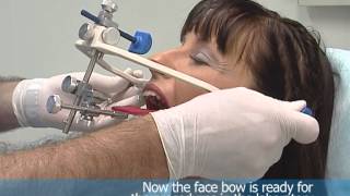 Asa Easy Bow  New transfer System ASA DENTAL [upl. by Ilahsiav]