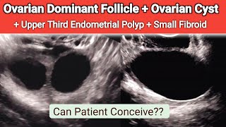 Ultrasound Dominant Follicle and Ovarian Cyst  Small Endometrial Polyp [upl. by Keir141]