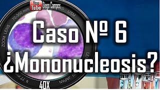 caso clinico Nº 6  Mononucleosis infecciosa [upl. by Namya]