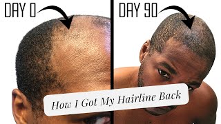 Derma Rolling for a Receding Hairline  Unedited Progress Pics [upl. by Enelrahs]