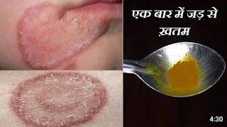 fungal infection  treatment for fungal infection  skin infection treatment  itching treatment [upl. by Lexine733]