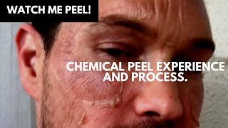 WATCH ME PEEL MY CHEMICAL PEEL EXPERIENCE AND PROCESS OF TCA ACID CHEMICAL PEEL [upl. by Jenei]