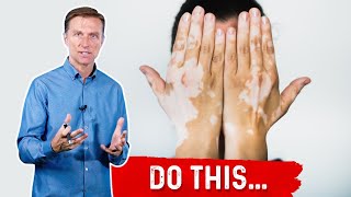 Vitiligo Do These 3 Things [upl. by Bahner]