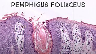 Pemphigus foliaceus autoimmune skin blister immunobullous disease in pemphigus vulgaris family [upl. by Ahon]