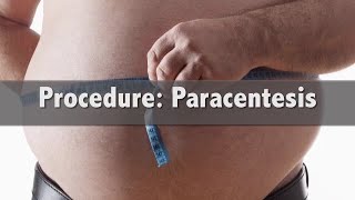 How is a Paracentesis completed and why [upl. by Nosirb]