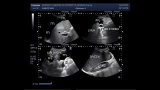 Ultrasound Video showing the Cirrhosis of the liver [upl. by Englis]