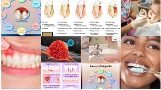 Ways to prevent Gingivitis from getting to the worse stage [upl. by Ji]