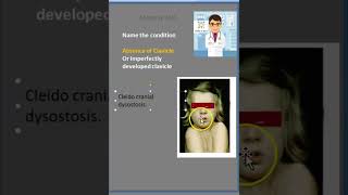 Anatomy Clavicle CCD CleidoCranial Dystosis [upl. by Kreindler]