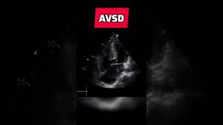 Atrioventricular septal defect  congenital heart defect echocardiography AVSD [upl. by Pickering]