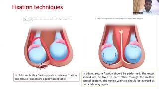 Testicular Torsion  Guidelines on management of Testicular torsion FRCS Urology Course [upl. by Airdnassac53]