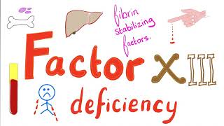 Factor XIII Deficiency  Fibrin Stabilizing Factor Defect [upl. by Euqnimod]