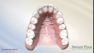 Trans Palatal Arch [upl. by Prochora258]