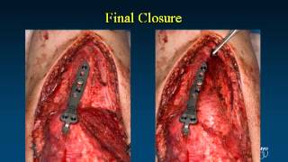 Fixation Options and Techniques for Distal Humerus Fractures VuMedi [upl. by Sonya565]