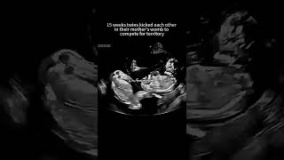 Ultrasound scan In Pregnancy [upl. by Akiner]