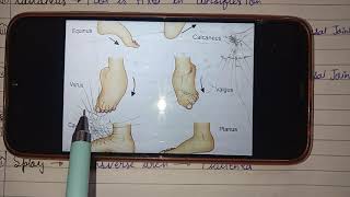 CTEV part1 Congenital Talipes Equino varus Club foot [upl. by Ennail517]