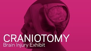 Craniotomy  Traumatic Brain Injury Animation [upl. by Kussell]