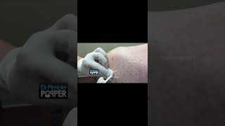 Disgusting or not drpimplepopper popaholics [upl. by Icnarf]