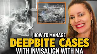 Invisalign with MA Deepbite Cases [upl. by Teague]