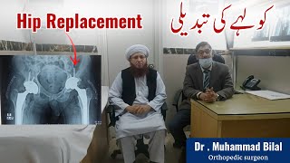 Bilateral Hip Replacement Review in Lahore Pakistan Kohle ki Tabdeli in Urdu [upl. by Rankin]