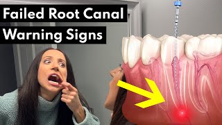 7 Warning Signs Your Root Canal FAILED [upl. by Ellenaej]