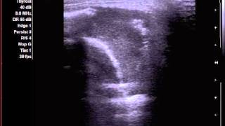 Os frontale arcus supercilialis  metastasis of kidney cancer [upl. by Holloway]