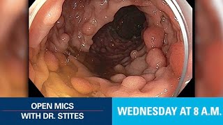 Open Mics with Dr Stites  Familial Adenomatous Polyposis [upl. by Rivard740]