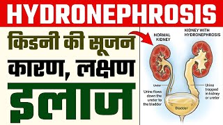 Hydronephrosis in Kidney  किडनी में सूजन के कारण लक्षण और इलाज  DR Puru Dhawan [upl. by Ihcalam]