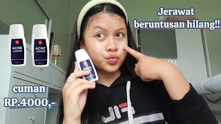 JERAWAT ILANG CUMAN PAKE INI REVIEW VIVA ACNE LOTION [upl. by Killy]