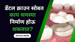 डेंटल क्राउन सोबत काय समस्या निर्माण होऊ शकतात   What Problems Could Develop with a Dental Crown [upl. by Mcgill]