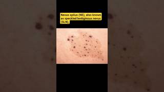 Nevus spilus NS  speckled lentiginous nevus SLNdrvaraprasad nevus awarenessaesthetic [upl. by Errehs]