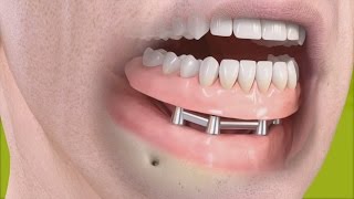 Straumann  Removable denture with bar [upl. by Ahsirtak]