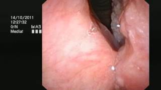 Cancer of the larynx voicebox  wwwdrjeevecom [upl. by Yug]