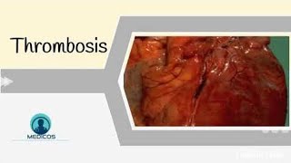 Thrombosis Part 2Morphology Fate amp Clinical Presentation of Thrombosis [upl. by Jankey]