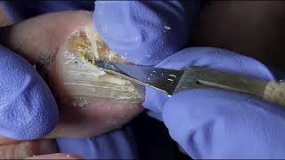 Ingrown Toenail Removal  Pedicure Treatment and Very Satisfying  Best Satisfying Nail Cutting [upl. by Coray]