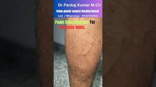 Foam Sclerotherapy treatment for varicose veins Varicose veins treatment before SSC GD medical [upl. by Adirem]