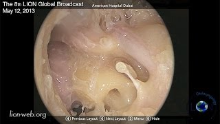 The 8th LION Global Broadcast May 16th 2013Endocopic anatomy of the middle ear [upl. by Charlot]