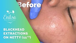 Blackhead Extractions on Netty  11th Treatment [upl. by Campagna]