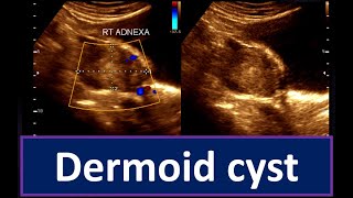 Understanding Dermoid Cyst  Guide to Ultrasonogram Diagnosis Ovarian Cyst  Practical Ultrasonogram [upl. by Ephram]