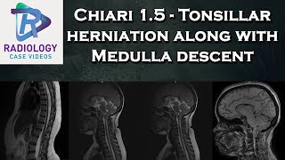 Chiari 15  Tonsillar herniation along with Medulla descent [upl. by Bensen]