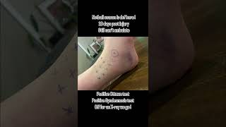 Syndesmosis Avulsion or Inc Sprain syndesmosis fibula sprainedankle podiatry netball [upl. by Davidson790]