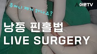 쾌감 영상 얼굴 턱 핀홀법 live surgery 낭종 수술 핀홀법 피지낭종 표피낭종 성형외과 서울 병원 epidermal cyst pinhole아문TV [upl. by Luehrmann]