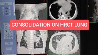 Consolidation on HRCT of Lungs  15 month 👶Baby [upl. by Ylrevaw]