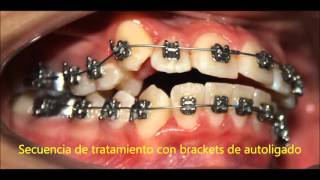 CASO CLINICO Brackets Autoligado y Elasticos [upl. by Etteniuq]