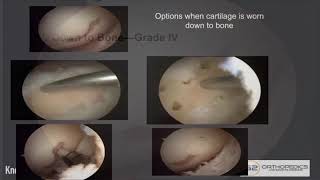 Treatment Options When Cartilage Is Worn Down to Bone [upl. by Atinyl665]